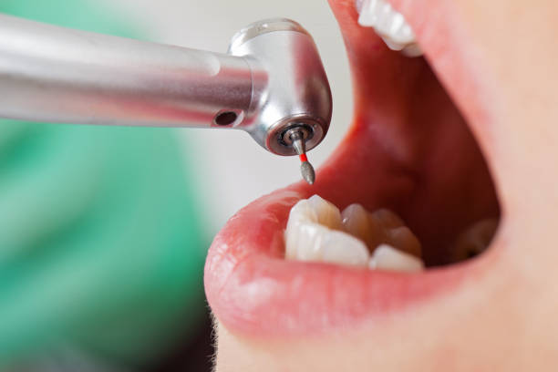 Best Emergency Wisdom Tooth Extraction in Brownville, NJ
